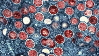 National Institute of Allergy and Infectious Diseases shows a colorized transmission electron micrograph of monkeypox particles